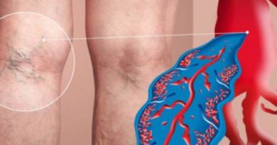 OPASNO PO ŽIVOT! OVO SU PRVI SIMPTOMI TROMBOZE: Ne odgađajte posjetu doktoru! OPASNO PO ŽIVOT! OVO SU PRVI SIMPTOMI TROMBOZE: Ne odgađajte posjetu doktoru!